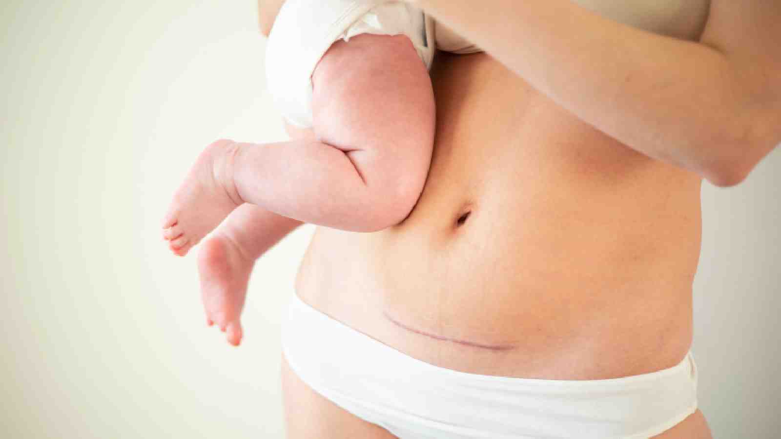 Caesarean delivery: All you should know about it