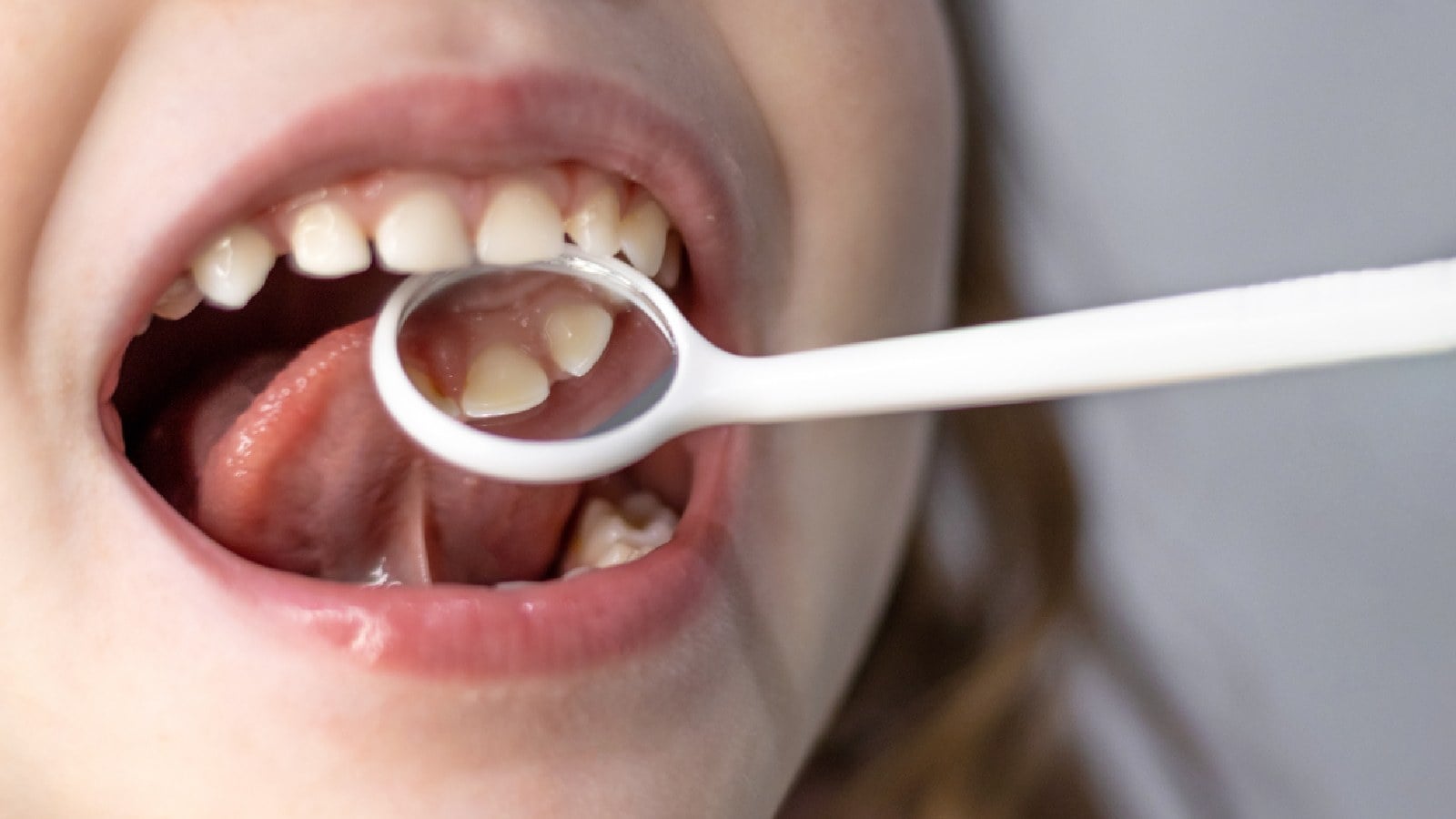 Know the early signs of tooth decay in children